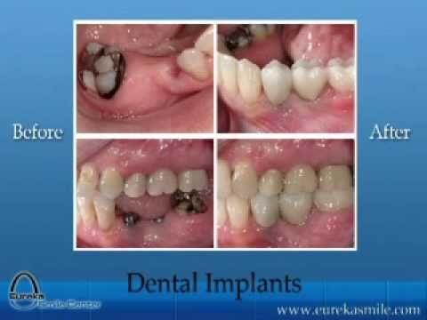 Here are the top ranked dental implants in St Louis who may be able to help:    Cost St Louis, MO. www.doctoroogle.com/st-louis-cost-dental-implants .