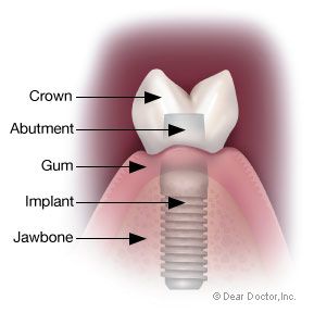 Failed dental implant after 18 months, 2 bone grafts and $6000 costs!  check   ups every 2 weeks, later every month, etcyou get the picture.