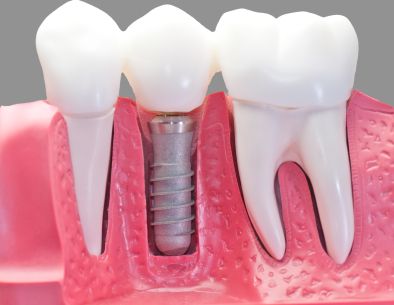 There are several medical risk factors against providing dental implants. The   most common of these are smoking and diabetes. This does not mean implants 