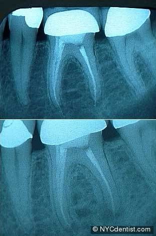1) The initial dental xray shows an oval-shaped radiolucency in the middle of the   tooth length; it is the site of the internal resorption. The patient was informed of 