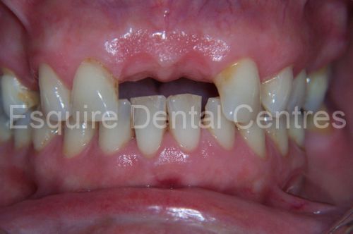 92 before and after Dental Implants photos posted by real doctors. Read reviews   and cost  Dental Implants For Missing Front Teeth · Dental Implant for Missing 