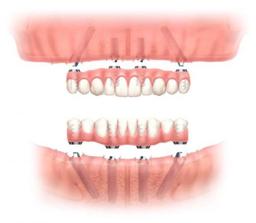 I have really failing teeth. My upper  If there is a failure it may just be one   implant. It would be  I elected to go for the all on 4 - implants/ teeth in a day.   Years of 