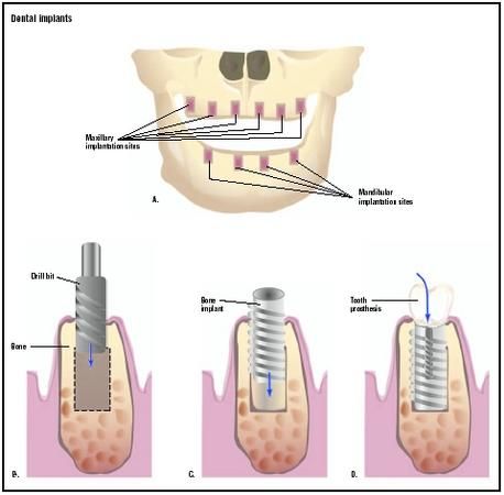 Patient Self-Care Following Implant Exposure Surgery. ACTIVITY: After leaving   our dental office today, we suggest you consider relaxing or at least limiting your 