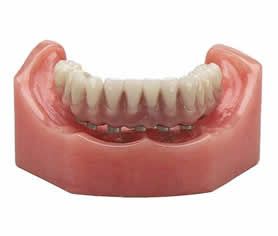 Replace your missing teeth with full or mini implant dentures, which out  There   are two types of implant retained dentures: Removable Overdentures and 