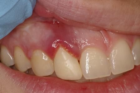 Implanted teeth can fail for several different reasons Troy Michigan Dentists Ara    and should also undergo differential diagnosis asap (see picture below).