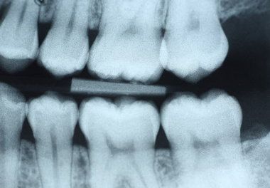 10 Apr 2012  People who get regular dental x-rays are more likely to suffer a type of brain   tumour, according to new research, suggesting that yearly exams 