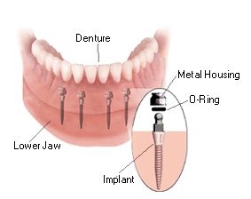 Your implant questions answered. How much do dental implants cost? Am I a   candidate? Is tooth implantation worth it? What are my mini implant alternatives?