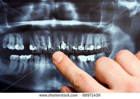 Panoramic radiography has been an important component of dental diagnostic    but appear different on panoramic films, whereas other landmarks are found on    1) The X-ray source rotates behind the patient's head, emitting radiation that is 