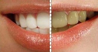 Exclusive Teeth whitening service in Birmingham from J'adore. Using the newest   and most innovative techniques while keeping the cost cheap. Contact us  It is   not the laser teeth whitening as used by other teeth whitening in Birmingham.