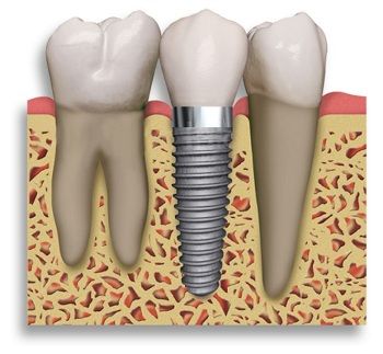 Bad implants can happen but can be avoided for many dental implant patients   Learn the details  Before and After Photos Osseointegration Implant Surgery 