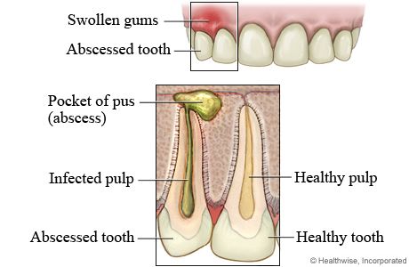 I needed a dental implant after redoing a crown that developed an infection  I   am wondering how long it would be normal to have throbbing (not really painful)?