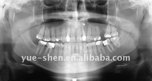 Dental X-rays Safety and FAQs. Radiographs, otherwise known as x-rays, have   come to be very important and necessary diagnostic tools for many medical and 