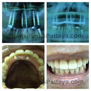 dental implants, why you would choose them, how to choose them, how to   choose a dentist,  All gave me the same pat answers, no price without   consultation,  All-On-6 titanium implants in upper jaw and plastic denture:   400,000 baht.