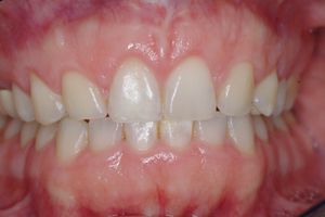 Some dentists have become crown/implant happy and recommend them . in my   case (extraction, bone graft, implant, and crown lengthening).