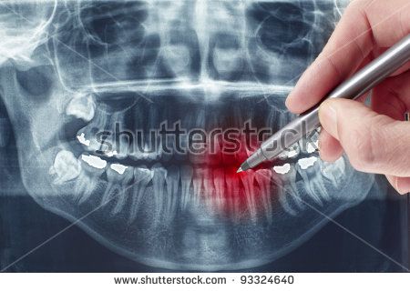 dental panoramic radiograph  Imagine the panoramic detector (e.g., X-ray film)   wrapped around the  soft tissues, bony and dental landmarks have been la- 