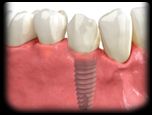 Dental Implant Pain After Crown Placement – Find Local Dentist Near ...