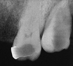 Dental Radiology: A discussion of the common errors technicians make when    Before placing an x-ray film in a patient's mouth, check to make sure that it is not    but the following table summarizes common film processing errors, the results, 