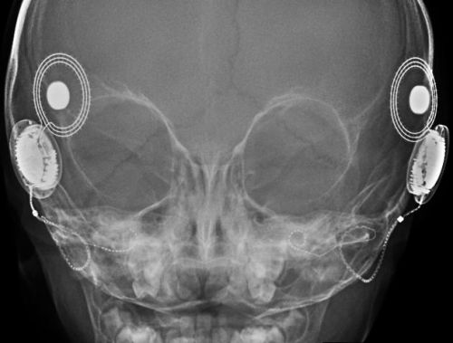 What is a 'Microlink'? Are MRI scans safe with a cochlear implant? Can I have an   x-ray at the dentist? Do I need to avoid magnetic toys or magnetic underlays?