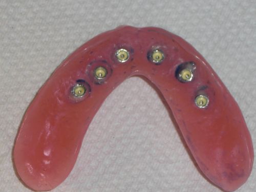 5 Jun 2006  I have been placing mini implants for 5 years now on both upper and lower jaw.    Can anyone coment on intermezzo mini dental implant system.  by my dentist   that I should have mini denture implants put in my upper jaw, 