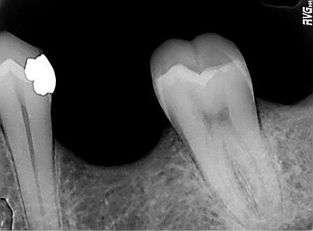 There are several ways to save on the cost of dental implants in Cleveland - like   mini implants or  Our research has shown that we fall well within the average   price range for the Cleveland area.  Hylan Dental Care, Cleveland, OH 44111 