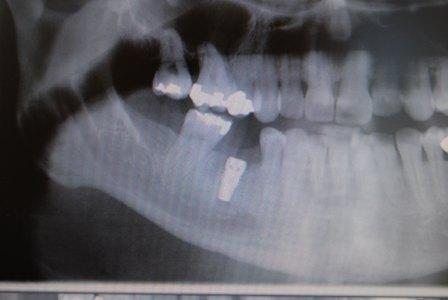 Implanted teeth can fail for several different reasons Troy Michigan Dentists Ara   Nazarian  Untreated bad implants can cause more extensive jaw bone damage    and should also undergo differential diagnosis asap (see picture below).