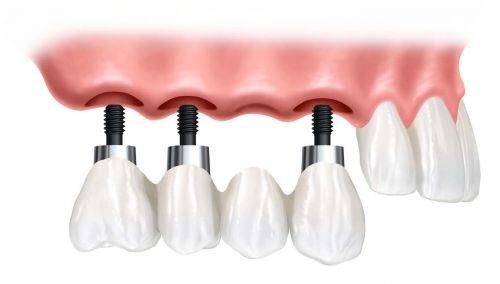 In most cases, when an implant-supported bridge is used, one implant is placed   in the jawbone for each missing tooth. Then the crowns are connected to each 