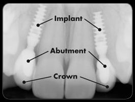 Cost of various dental implants at Dr. Motiwala dental 