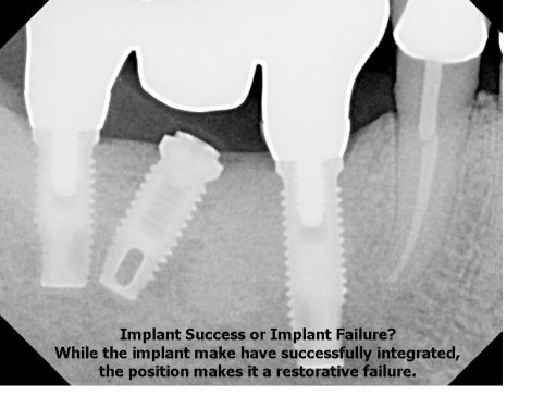 Dental Implant Failure. Most implants placed today are root form implants. Root   form implants problems can be classified as ailing, failing, or failed: Failed 