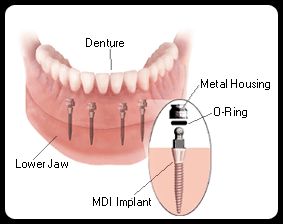 Potsdam Center for Innovative Dental Technologies is your Potsdam, Canton,   and Massena, NY (New York) dentist, providing quality dental care for children, 