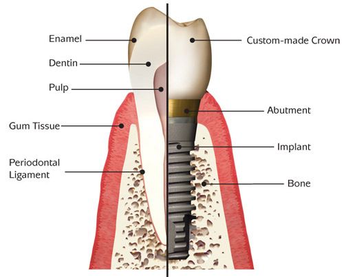 Dental implant surgery can offer a welcome alternative to dentures or bridgework   that doesn't fit well. How dental implant surgery is performed depends on the 